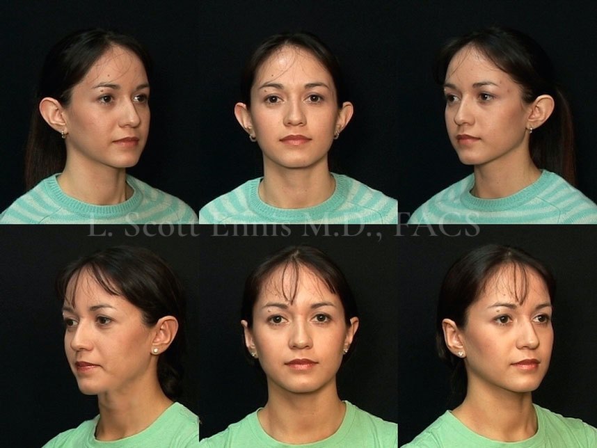 Otoplasty Before & After