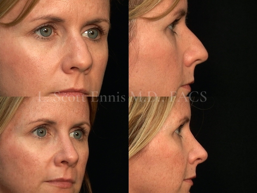 Before and After Ennis Plastic Surgery Palm Beach Boca Raton Destin Miami Fort Lauderdale Florida