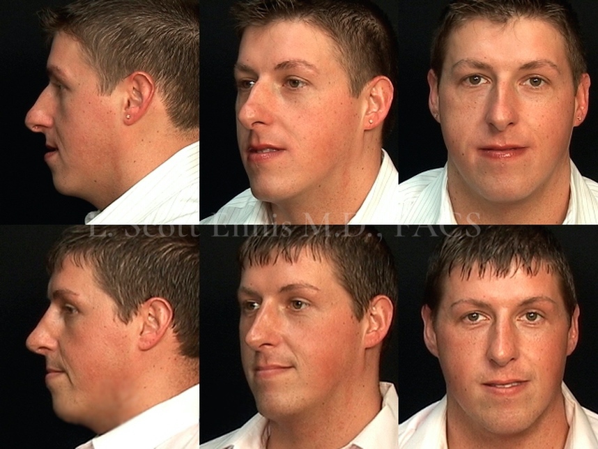 rhinoplasty-before-after-scott-ennis-md-destin-palm-beach-118960 (1)