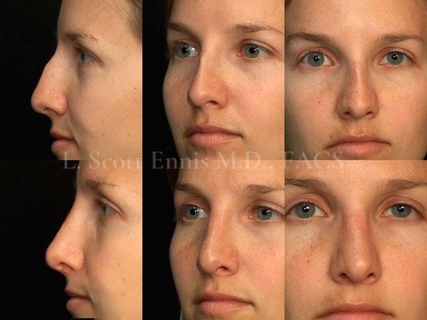 Rhinoplasty Before & After