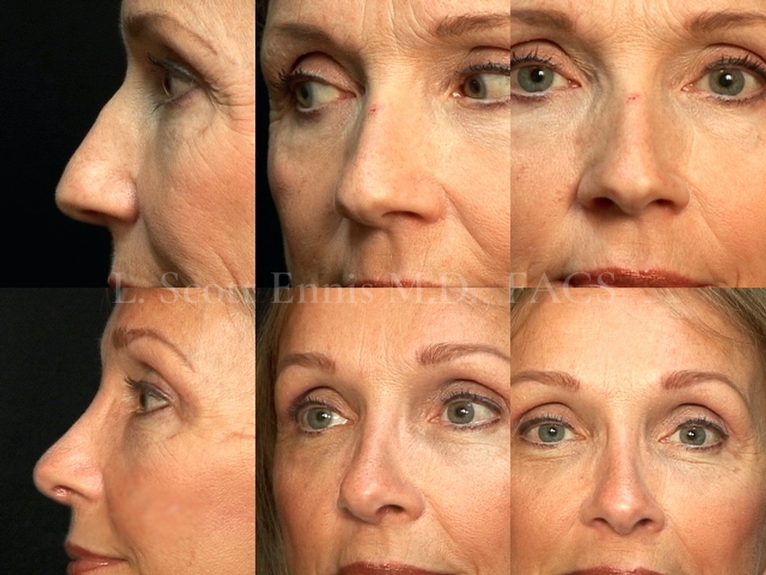 Before and After Ennis Plastic Surgery Palm Beach Boca Raton Destin Miami Fort Lauderdale Florida