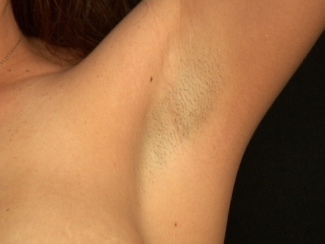 Underarm Minimal Scar 3