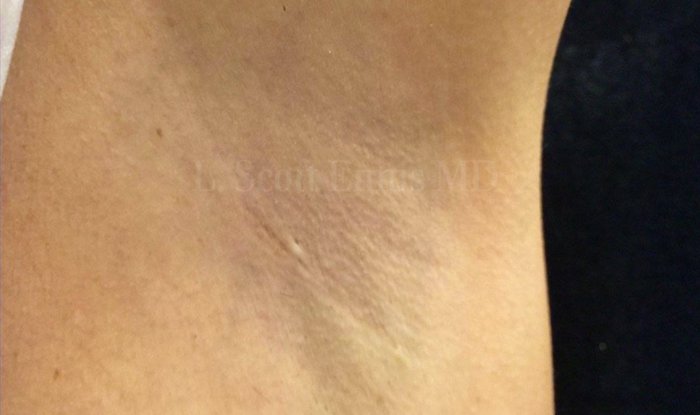 transaxillary breast augmentaiton scar Miami, Boca Raton, Fort Lauderdale