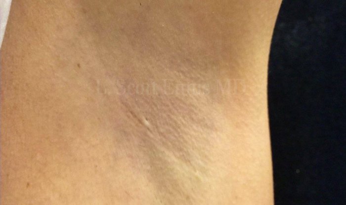 Augmentation Scae Ballerina Breast Augmentation in Florida with Dr. Scott Ennis
