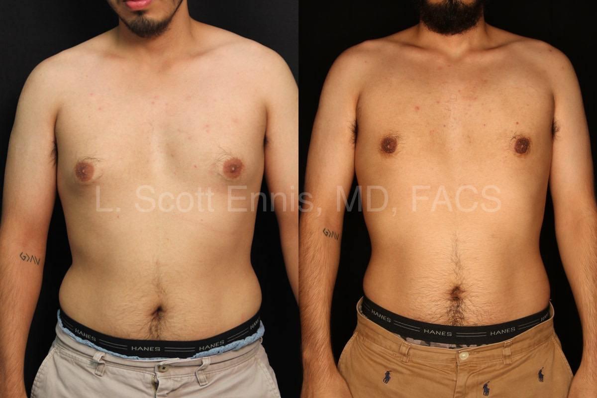 Liposuction of the chest with Subcutaneous Mastectomies for gynecomastia-Before-and-After-Photo-Ennis-Plastic-Surgery-Palm-Beach-Boca-Raton-Fort Lauderdale Destin-Florida-