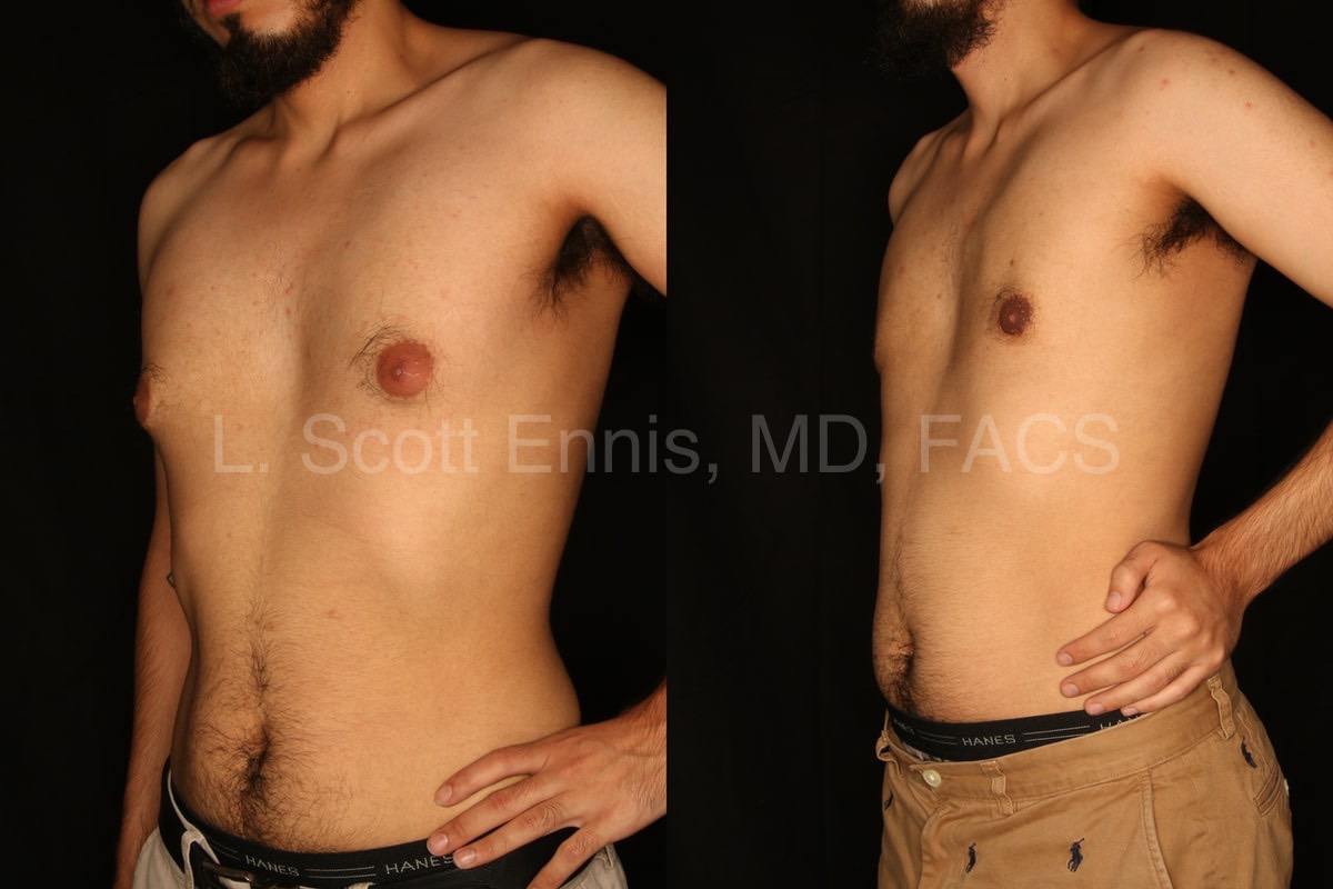 Liposuction of the chest with Subcutaneous Mastectomies for gynecomastia-Before-and-After-Photo-Ennis-Plastic-Surgery-Palm-Beach-Boca-Raton-Miami Destin-Florida-