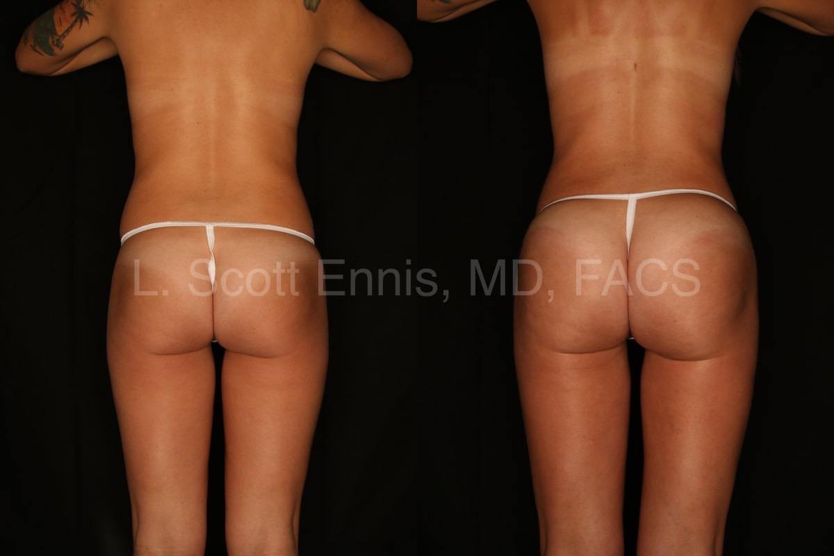 BBL harvested from hips abdomen and medial thighs lipoinfiltration Brazilian Butt Lift-Before-and-After-Photo-Ennis-Plastic-Surgery-Palm-Beach-Boca-Raton-Destin-Miami Florida