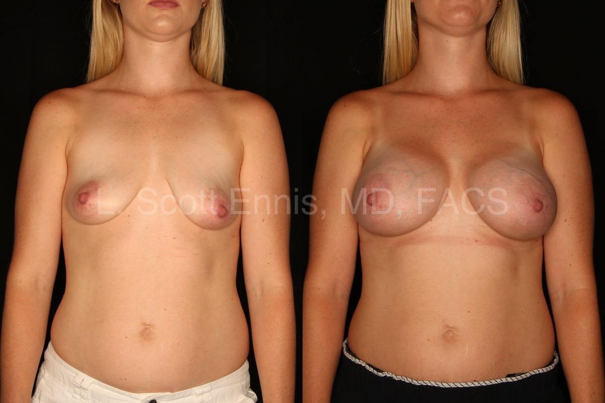 transaxillary breast augmentation with silicone no scar on the breast-Before-and-After-Ennis-Plastic-Surgery-Miami Palm-Beach-Boca-Raton-Destin-Florida-50262-2-min