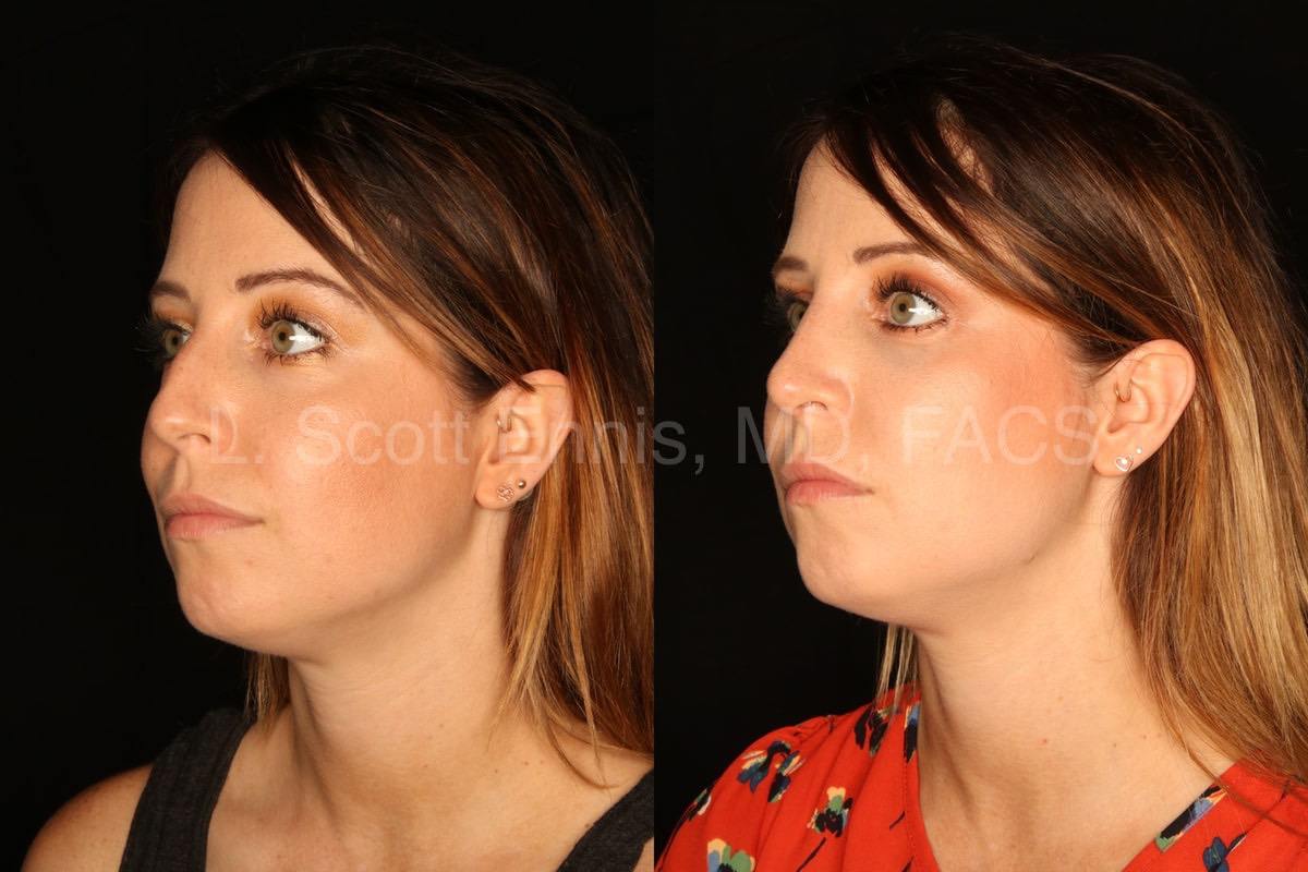 rhinoplasty with osteotomies Lower Blepheroplasty Before-and-After-Ennis-Plastic-Surgery-Palm-Beach-Miami Boca-Raton-Destin-Florida-50311-7-min