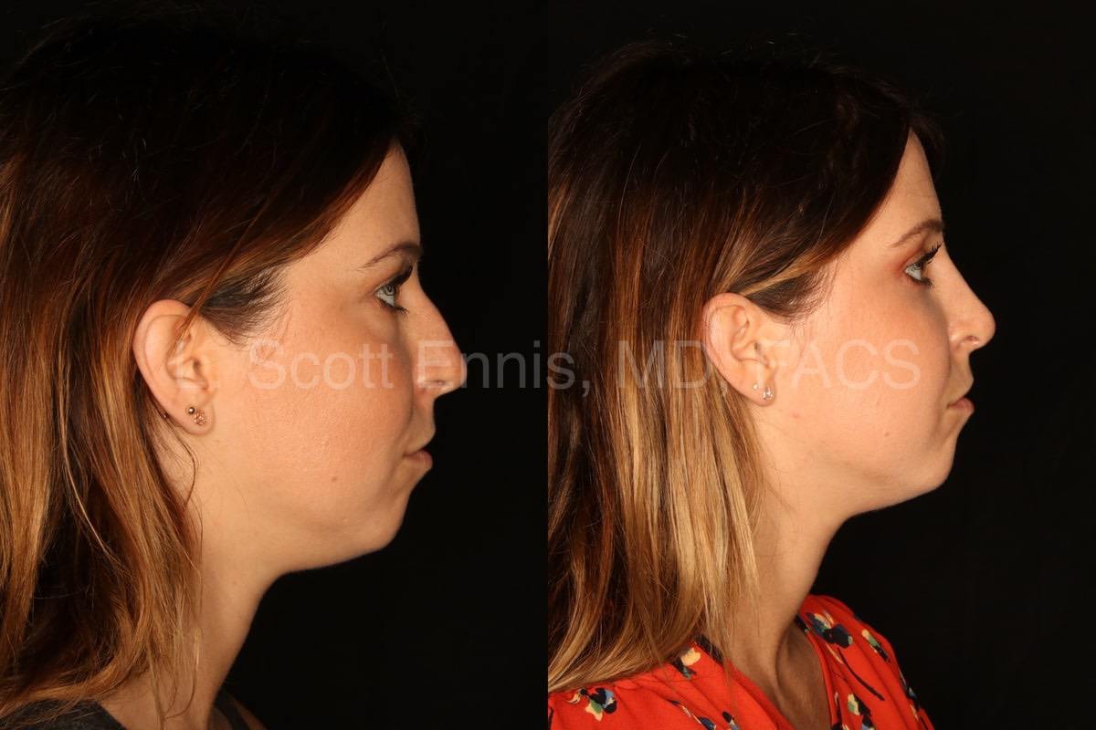 rhinoplasty with osteotomies and septal cartilage grafts-Before-and-After-Ennis-Plastic-Surgery-Palm-Beach-Boca-Raton-Destin-Florida-50311-9-min