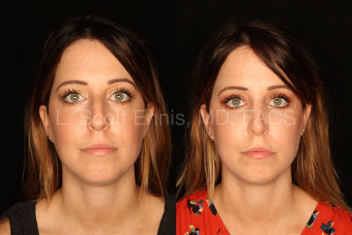 Dr. Ennis rhinoplasty patient before and after