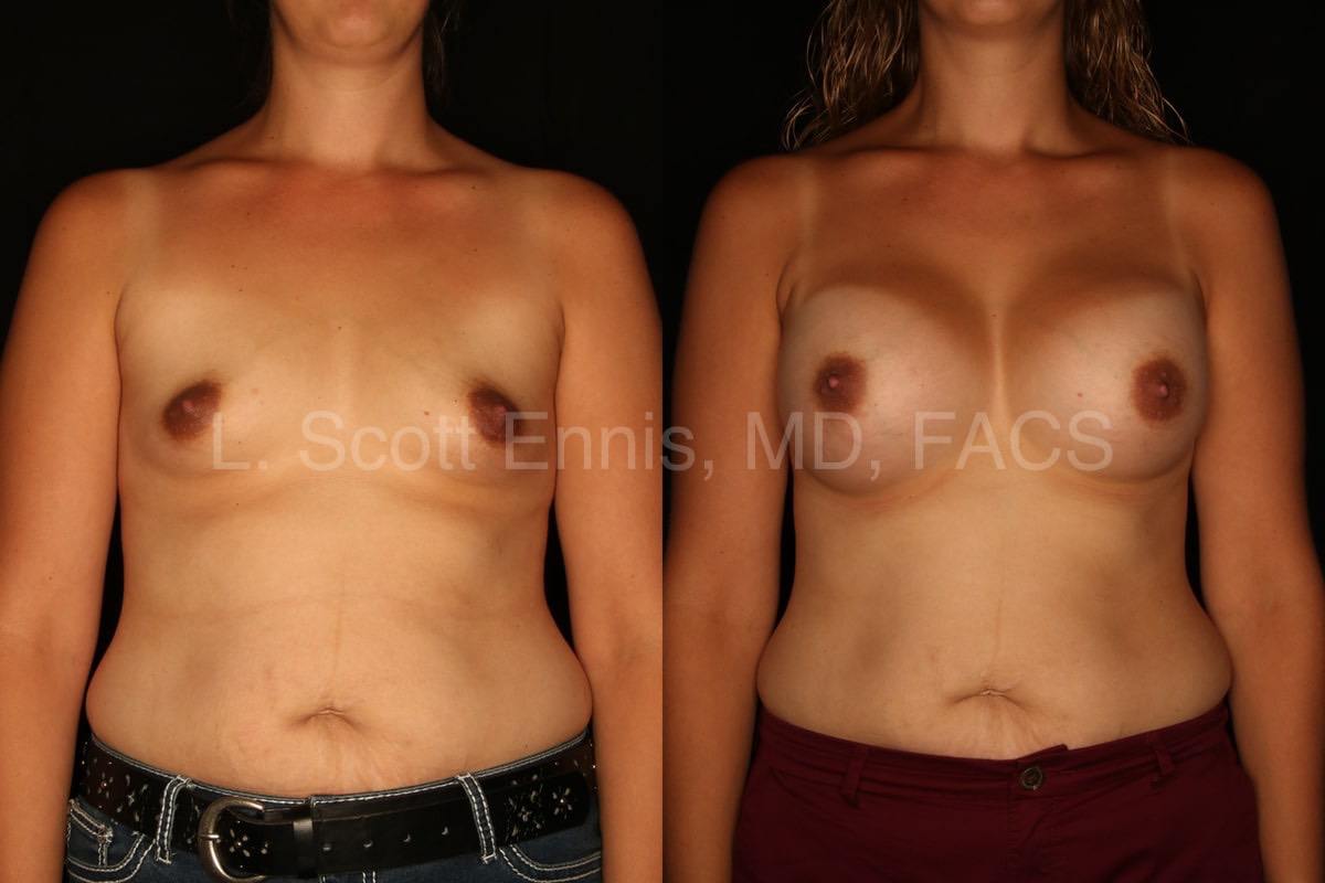Bil Endoscopic transaxillary breast Augmentation with Silicone L550, R600-Before-and-After-Ennis-Plastic-Surgery-Palm-Beach-Boca-Raton-Destin-Miami Florida-41285-min