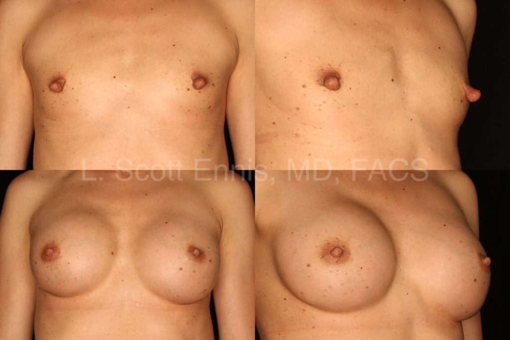 37YOF transaxillary augmentation with silicone, bilateral nipple shortening reduction-Before-and-After-Ennis-Plastic-Surgery-Palm-Beach-Boca-Raton-Destin-Florida-50410-4-min