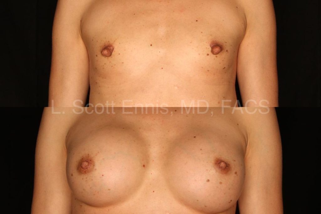 37YOF transaxillary augmentation with silicone, bilateral nipple shortening reduction-Before-and-After-Ennis-Plastic-Surgery-Palm-Beach-Boca-Raton-Destin-Florida-50410-6-min