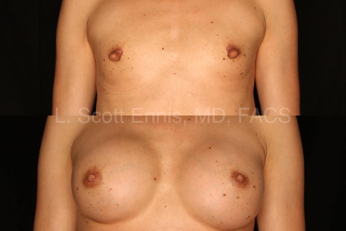 transaxillary breast augmentation with silicone, bilateral nipple shortening reduction-Before-and-After-Ennis-Plastic-Surgery-Palm-Beach-Boca-Raton-Destin-Florida-50410-6-min