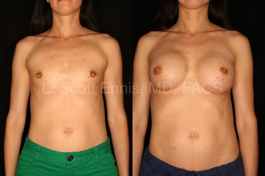 37YOF transaxillary augmentation with silicone, bilateral nipple shortening reduction-Before-and-After-Ennis-Plastic-Surgery-Palm-Beach-Boca-Raton-Destin-Florida-50410-min