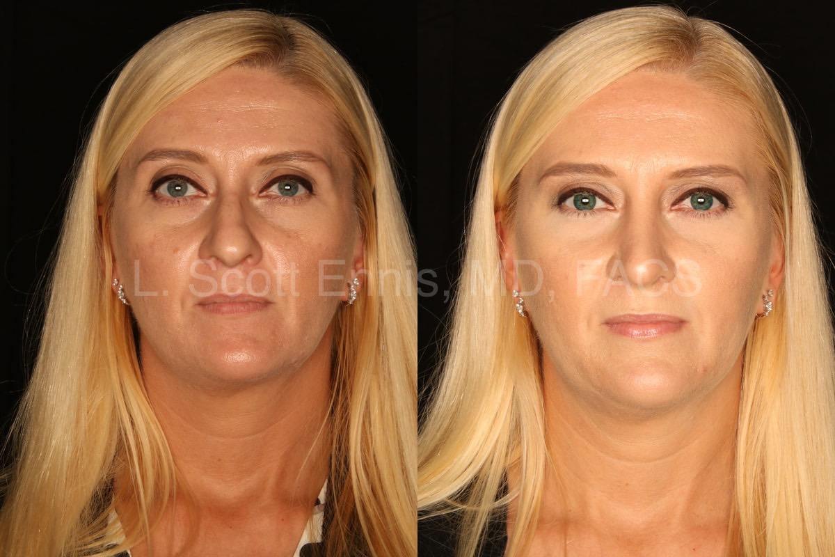 rhinoplasty with osteotomies and septal cartilage grafts-Before-and-After-Ennis-Plastic-Surgery-Palm-Beach-Boca-Raton-Destin-Florida-50311