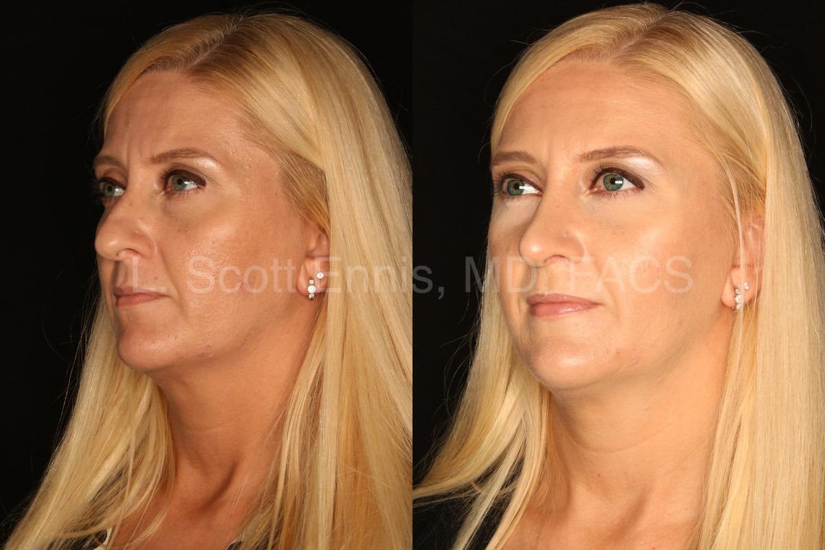 rhinoplasty with osteotomies and septal cartilage grafts-Before-and-After-Ennis-Plastic-Surgery-Palm-Beach-Boca-Raton-Destin-Florida-50311-6b-min