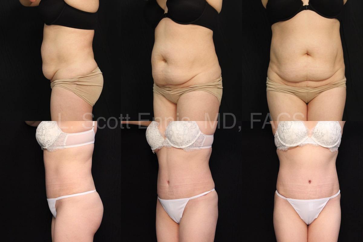 40 yof Drainless Abdominoplasty Tummy Tuck Before and After Photo Ennis Plastic Surgery Palm Beach Boca Raton Destin Florida 70524 1 min