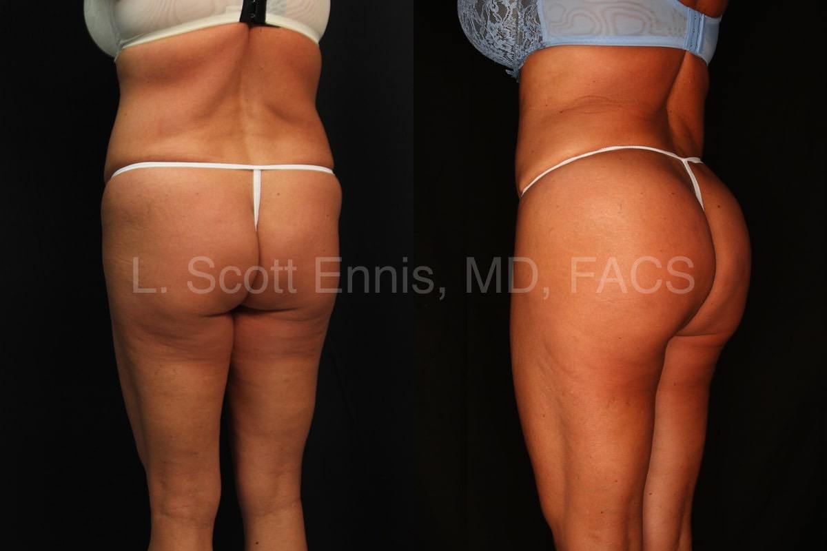 BBL - Brazilian Butt Lift-Before-and-After-Ennis-Plastic-Surgery-Palm-Beach-miami - Boca-Raton-Destin-Florida-