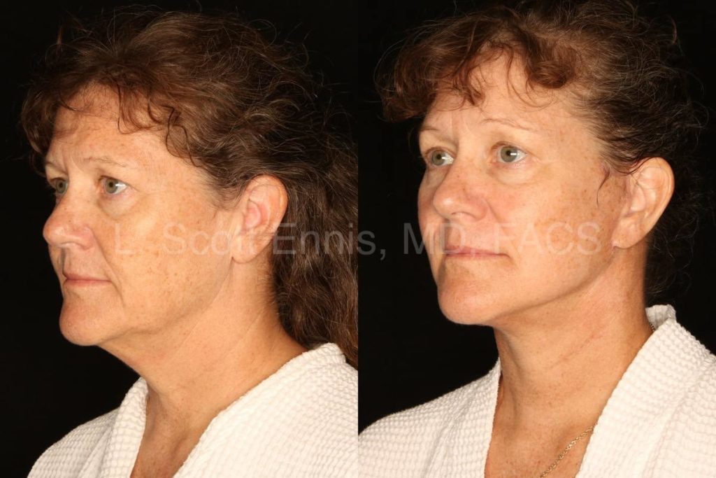 Before-and-After-Ennis-Plastic-Surgery-Palm-Beach-Boca-Raton-Destin-Florida-