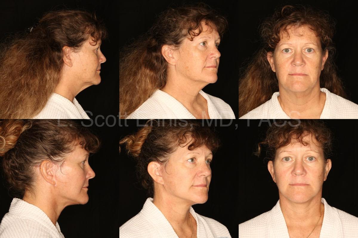 Before-and-After-Ennis-Plastic-Surgery-Palm-Beach-Boca-Raton-Destin-Florida-