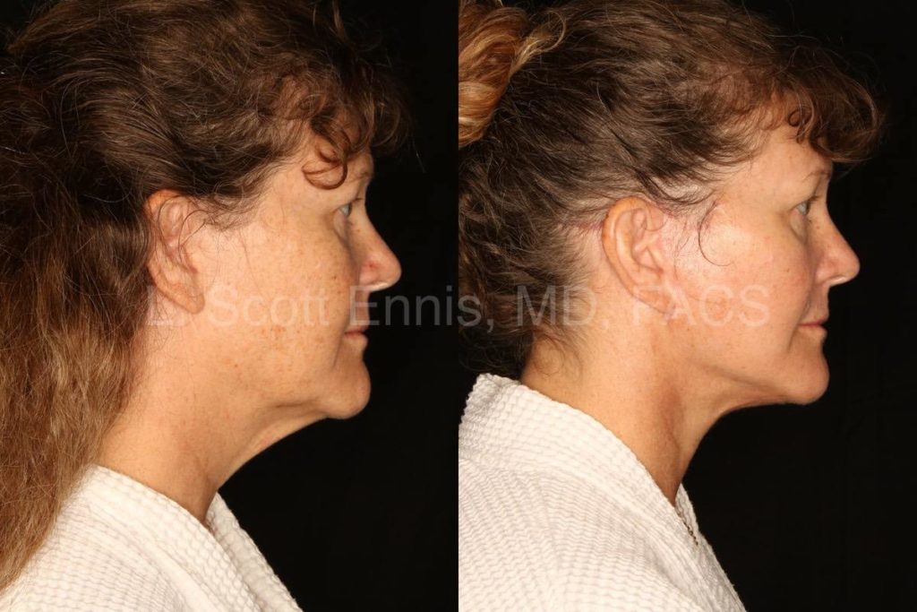 Before-and-After-Ennis-Plastic-Surgery-Palm-Beach-Boca-Raton-Destin-Florida-