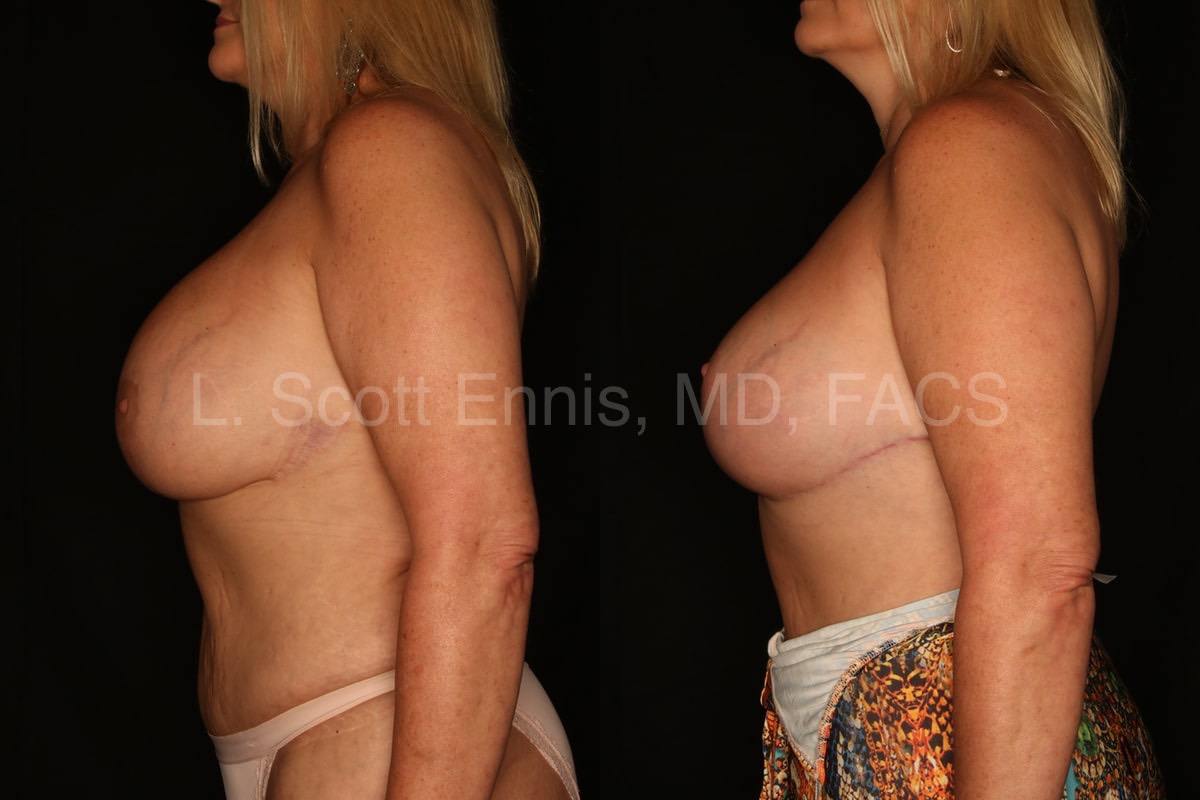 Before-and-After-Ennis-Plastic-Surgery-Palm-Beach-Boca-Raton-Destin-Florida-