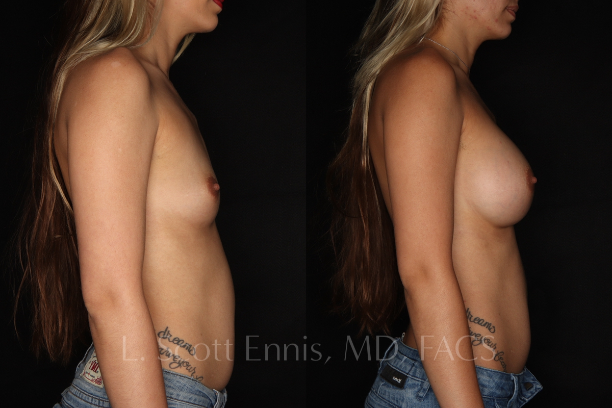 breast-Before-and-After-Ennis-Plastic-Surgery-Beverly hills, naples, miami, Palm Beach, Boca-Raton-Florida