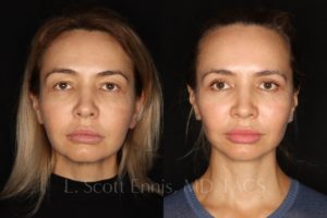 Face-Before-and-After-Ennis-Plastic-Surgery-Beverly hills, naples, miami, Palm Beach, Boca-Raton-Florida