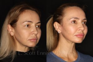 Face-Before-and-After-Ennis-Plastic-Surgery-Beverly hills, naples, miami, Palm Beach, Boca-Raton-Florida