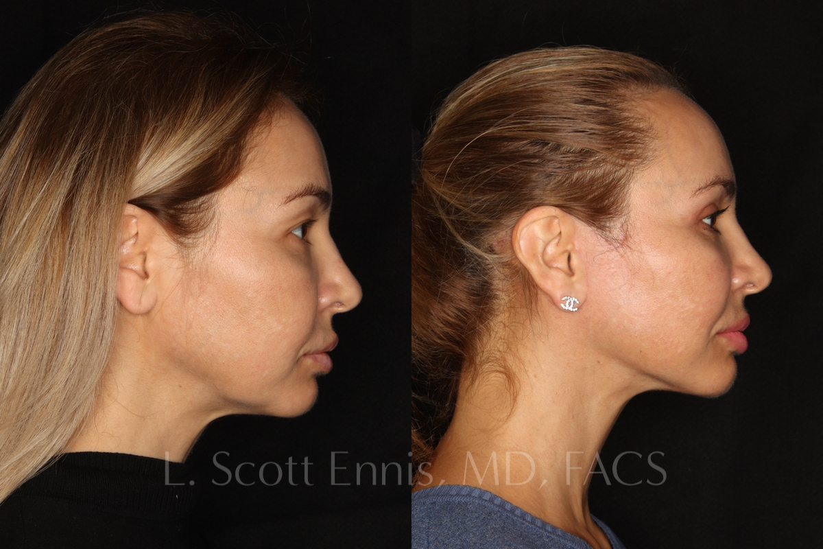 face-Before-and-After-Ennis-Plastic-Surgery-Beverly hills, naples, miami, Palm Beach, Boca-Raton-Florida