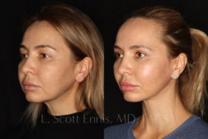 Face-Before-and-After-Ennis-Plastic-Surgery-Beverly hills, naples, miami, Palm Beach, Boca-Raton-Florida