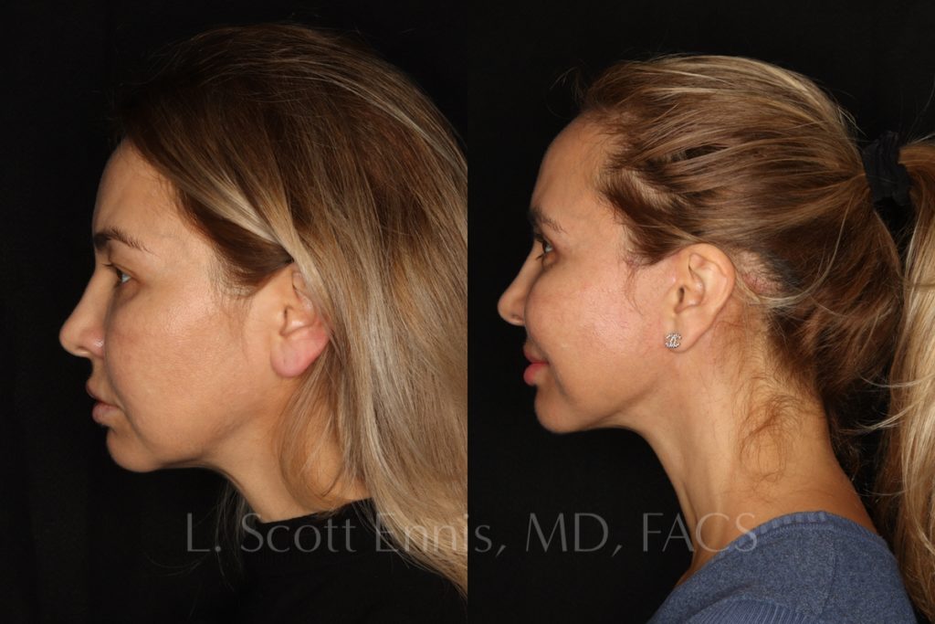 face-Before-and-After-Ennis-Plastic-Surgery-Beverly hills, naples, miami, Palm Beach, Boca-Raton-Florida
