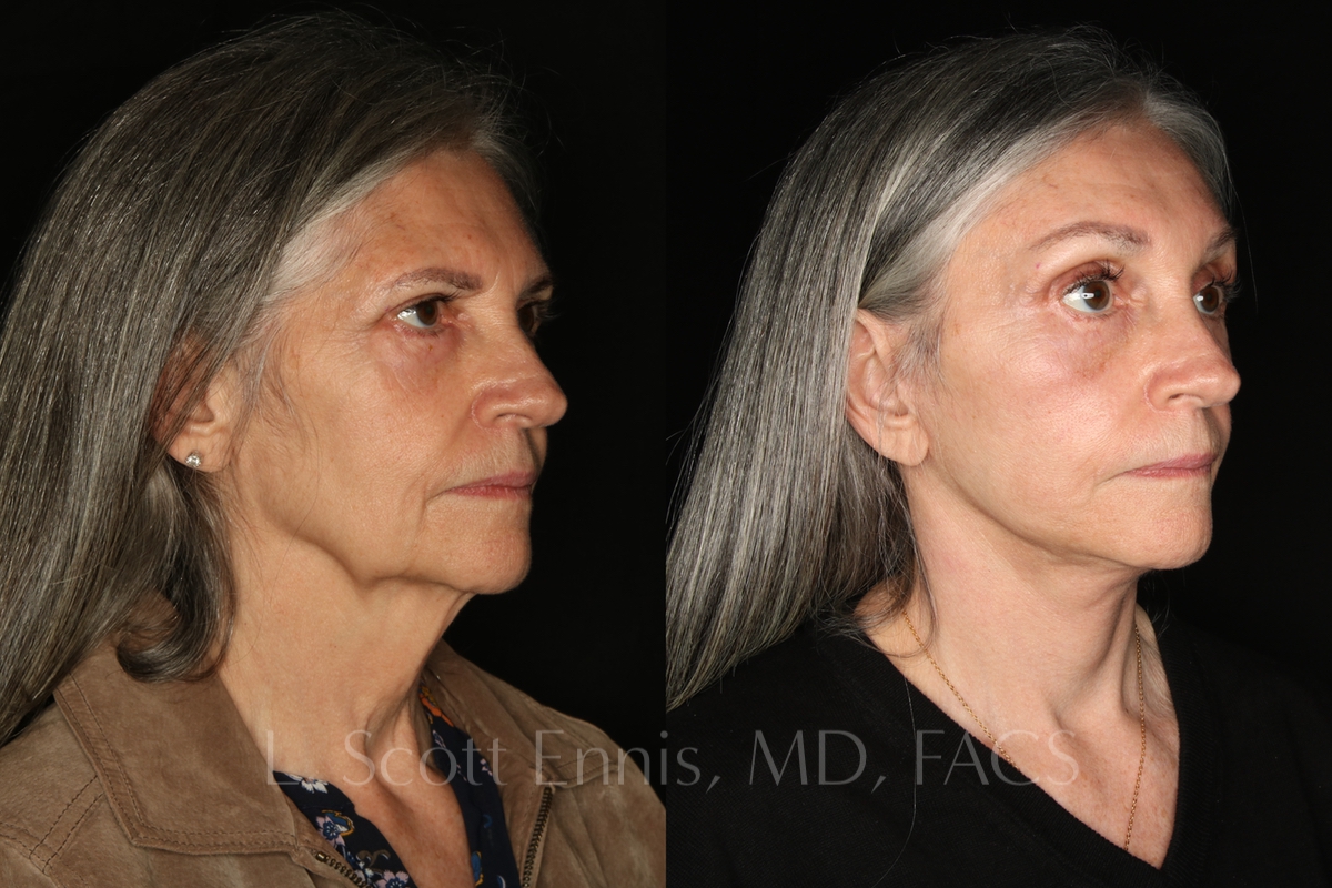 Face-Before-and-After-Ennis-Plastic-Surgery-Beverly hills, naples, miami, Palm Beach, Boca-Raton-Florida