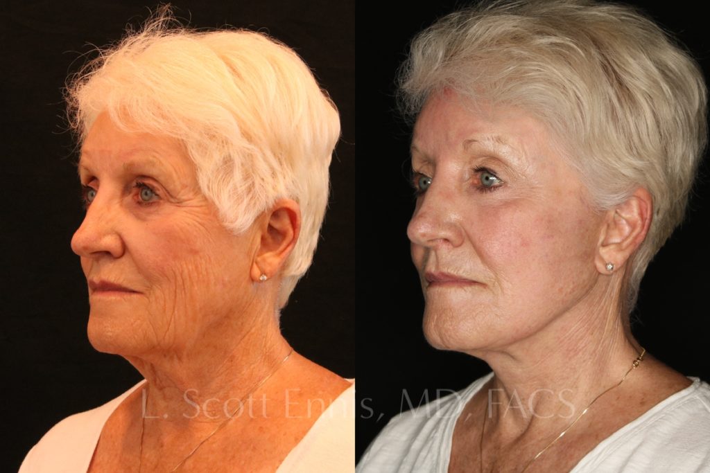 Face-Before-and-After-Ennis-Plastic-Surgery-Beverly hills, naples, miami, Palm Beach, Boca-Raton-Florida
