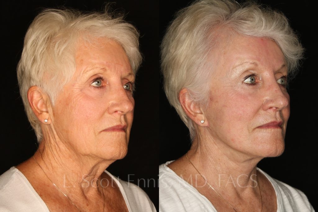 Face-Before-and-After-Ennis-Plastic-Surgery-Beverly hills, naples, miami, Palm Beach, Boca-Raton-Florida
