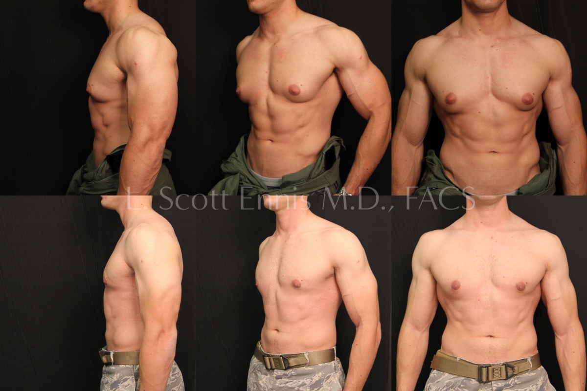 Gynecomastia- men -Before-and-After-Ennis-Plastic-Surgery-Beverly HIlls, Miami, Fort Lauderdale, Palm Beach, Boca-Raton-Florida