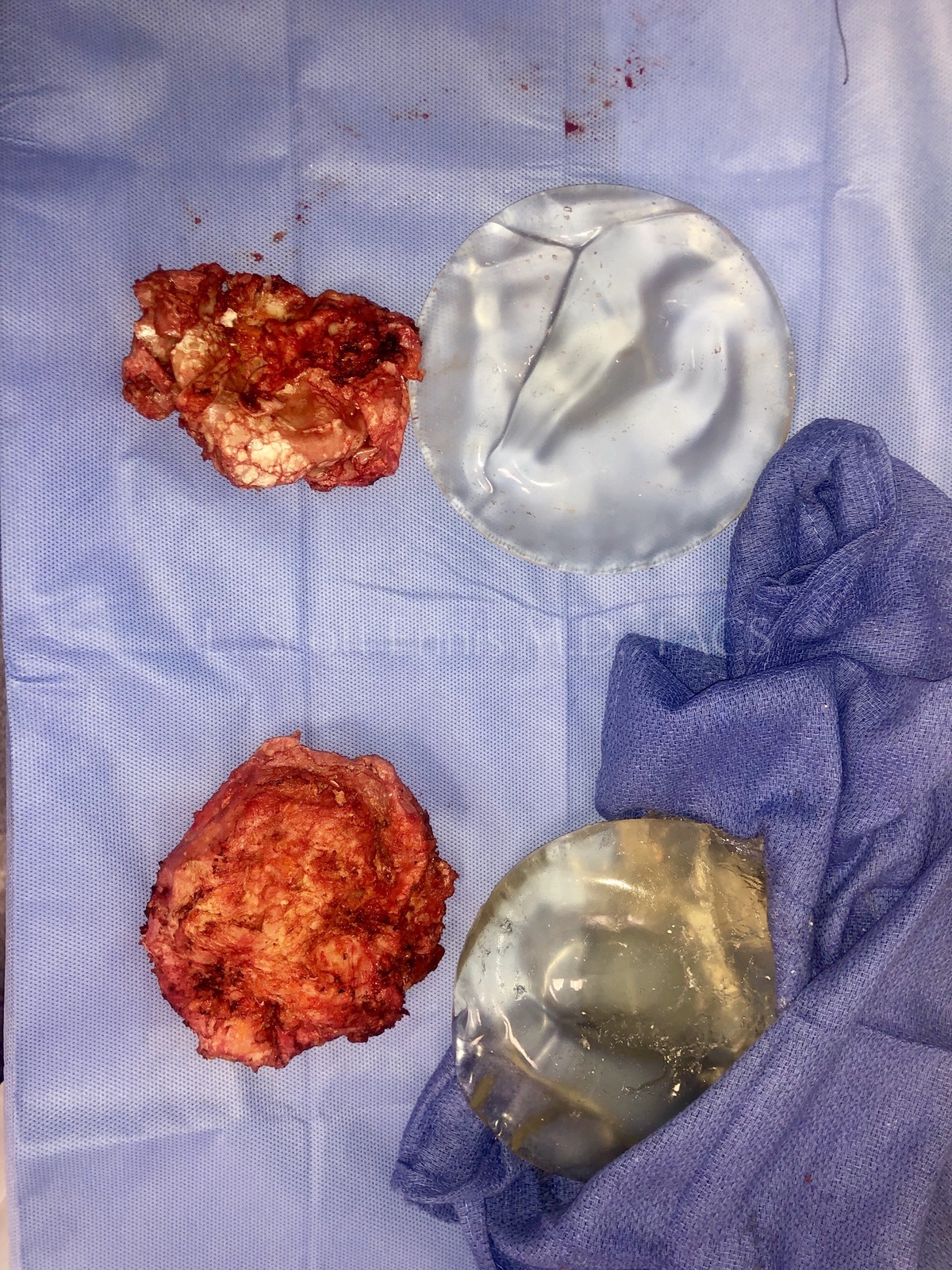 Breast implant and capsule removed during explant surgery