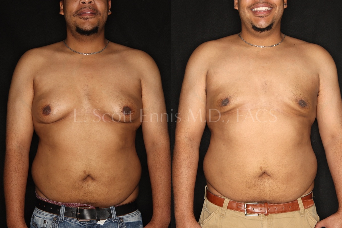 gynecomastia surgery before and after dr l scott ennis palm beach florida 3