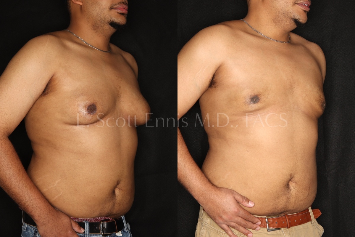 gynecomastia surgery before and after dr l scott ennis palm beach florida 1