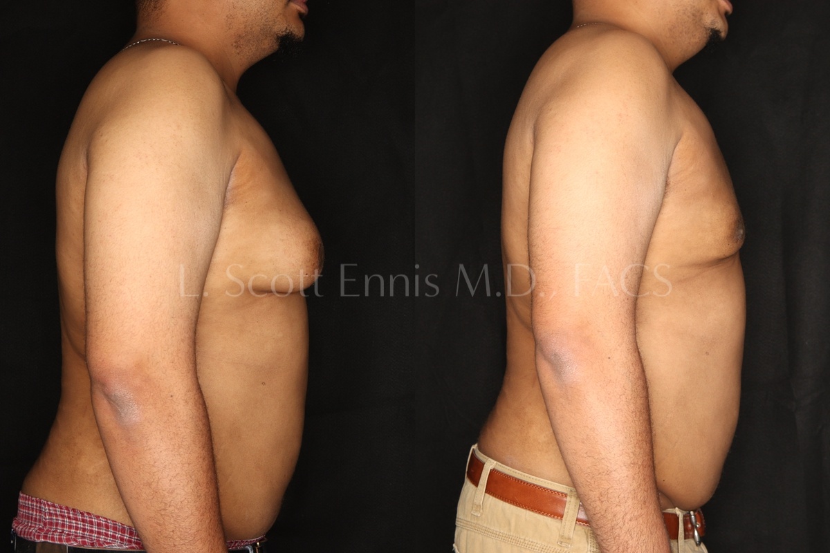 gynecomastia surgery before and after dr l scott ennis palm beach florida 2