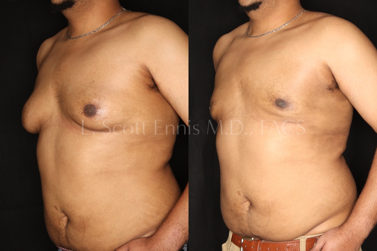 gynecomastia surgery before and after dr l scott ennis palm beach florida 4