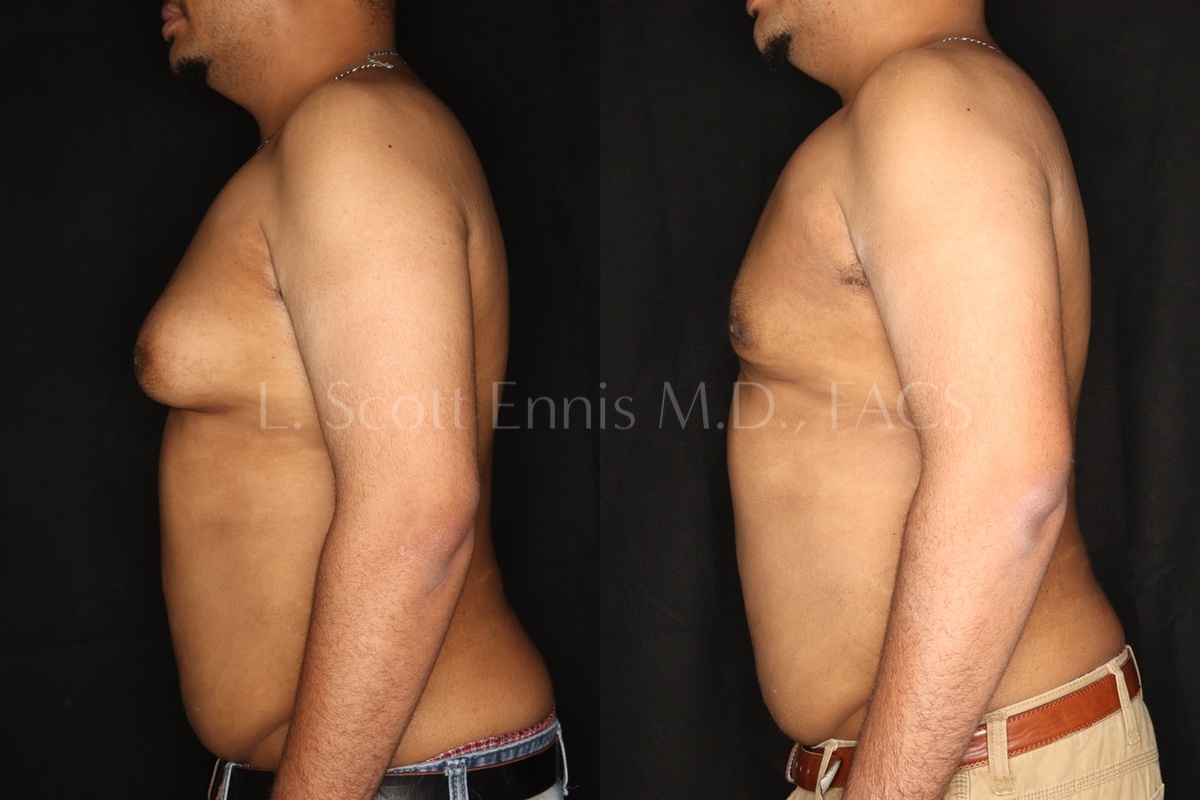 gynecomastia surgery before and after dr l scott ennis palm beach florida 5
