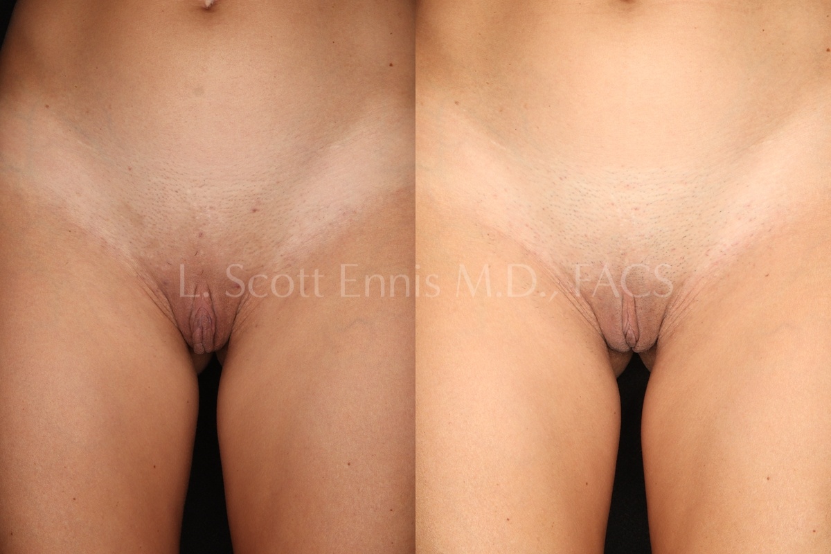 Labiaplasty with hoodectomy Dr Scott Ennis Plastic Surgery Boca Raton Palm Beach Fort Lauderdale Miami Florida 10234