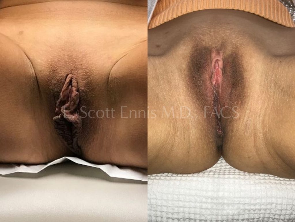 Labiaplasty with hoodectomy Dr Scott Ennis Plastic Surgery Boca Raton Palm Beach Fort Lauderdale Miami Florida 37638 Labiaplasty with hoodectomy Dr Scott Ennis Plastic Surgery Boca Raton Palm Beach Fort Lauderdale Miami Florida 37638
