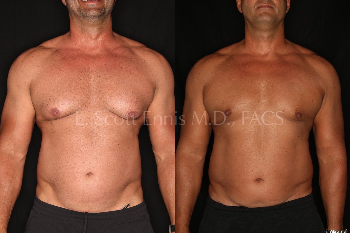 Liposuction - Male Chest Before and After Pictures Case 3