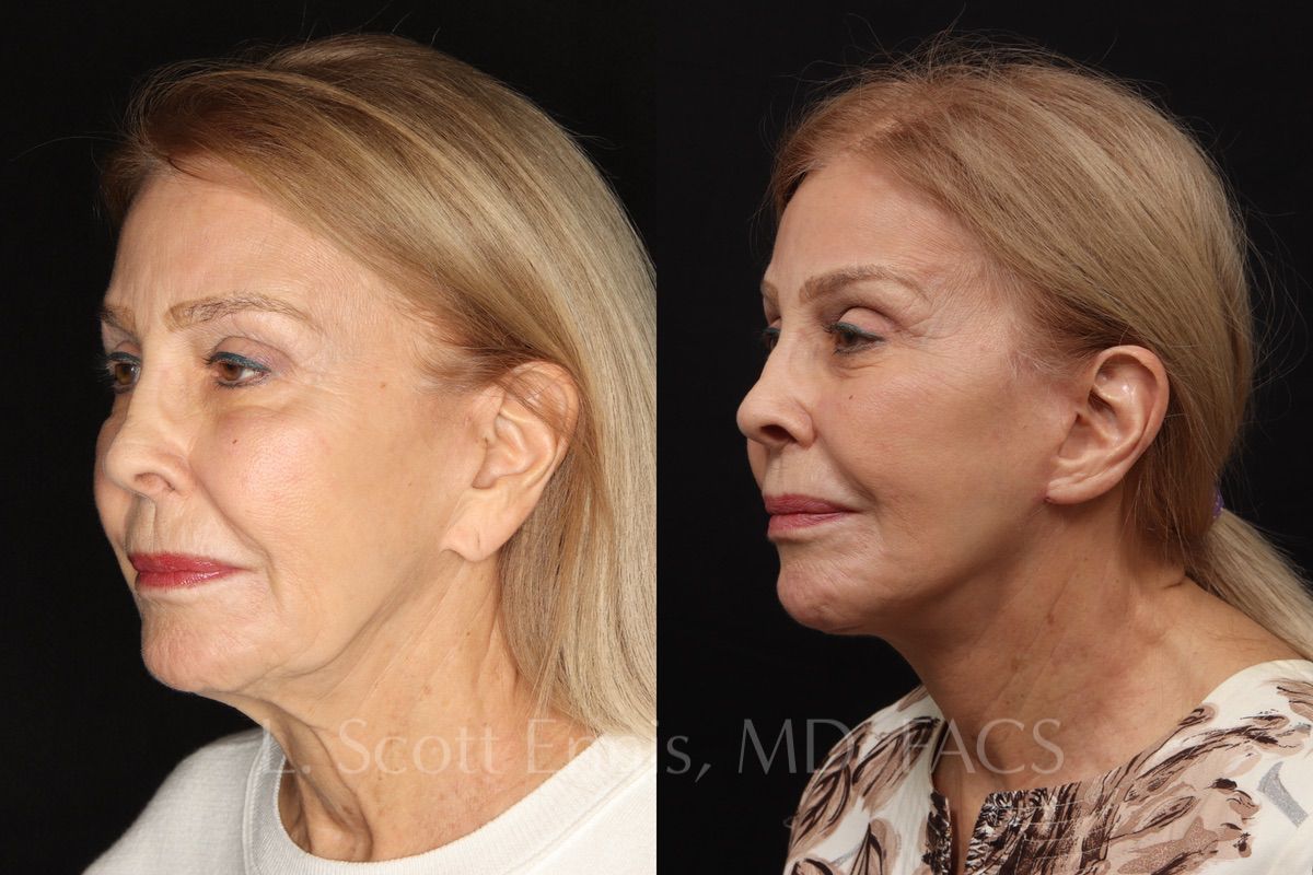 LIFTING FACIAL ( RITIDECTOMIA) – Stima