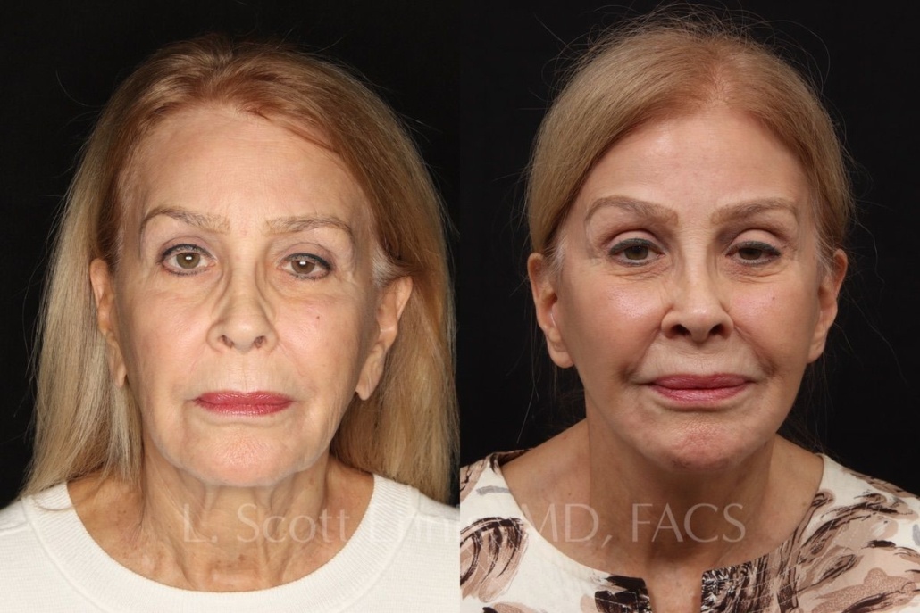 73-yo-secondary facelift-with earlobe reduction -Dr-L-Scott-Ennis-Boca-raton-Fort-lauderdale-maiami-Palm-Beach-Naples-51529 (2)