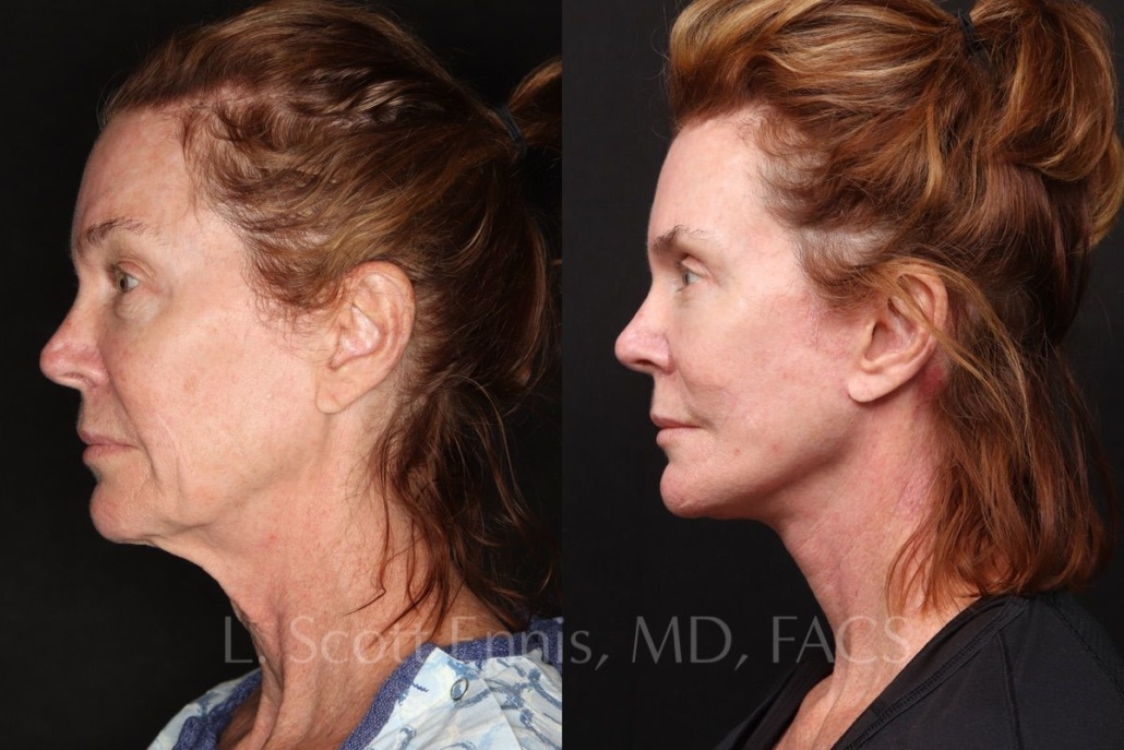 Deep Plane Facelift before and after